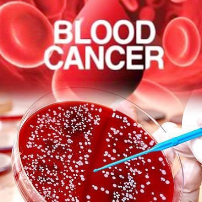 كل ما يهمك عن سرطان الدم