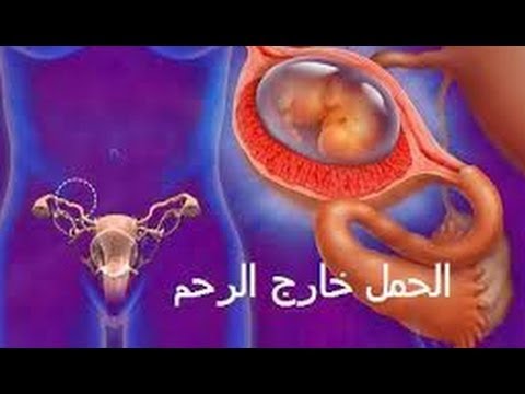 اعراض الحمل خارج الرحم