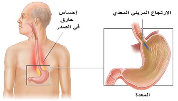 10 من أهم أعراض ارتجاع المريء ما هي عوارض ارتجاع المريء