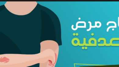 علاج الصدفية