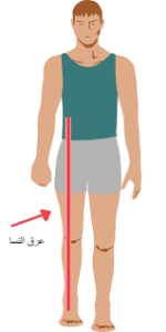 معلومات طبية عن مرض عرق النسا