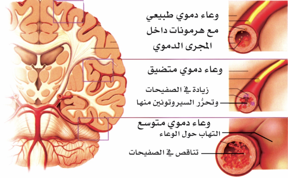 الصداع النصفي