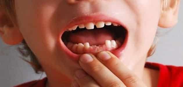 تفسير سقوط الاسنان في المنام