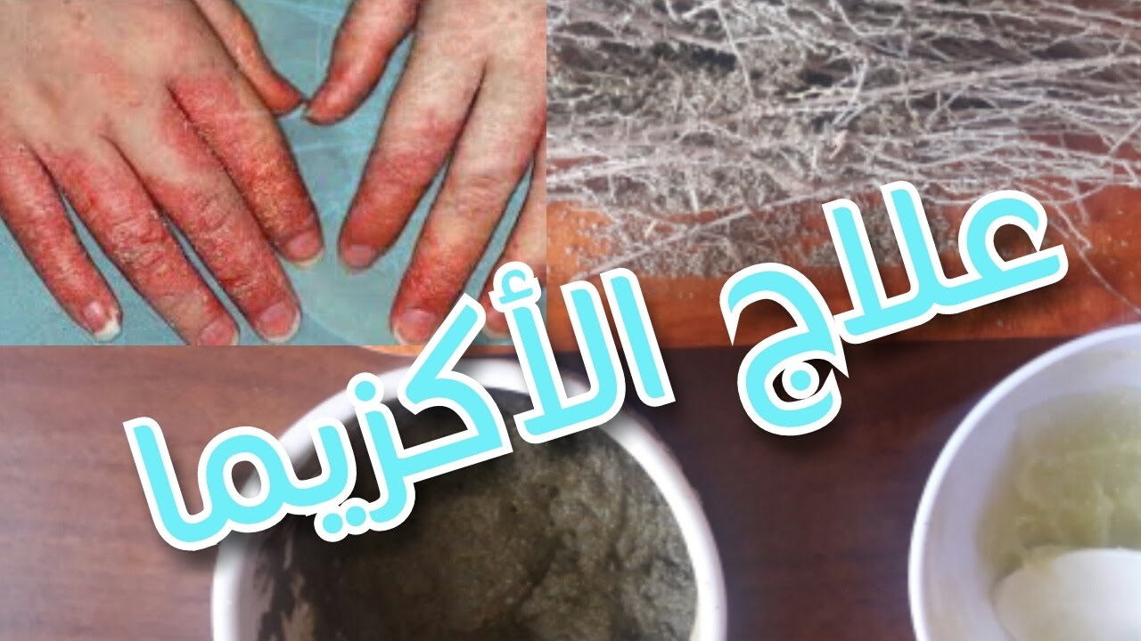 معلومات حول الإكزيما