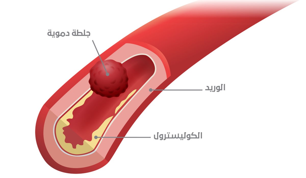 معلومات حول الجلطة