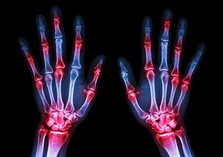 الروماتيزم يؤثر بشكل كبير على مفاصل اليد