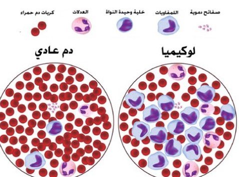 الفرق بين سرطان الدم والخلايا السليمة