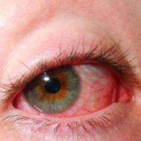 مرض بهجت يؤثر على العين بشكل كبير