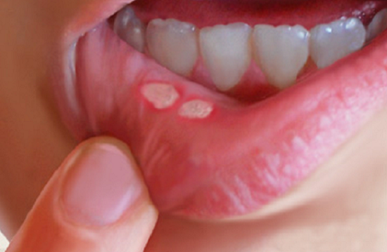 مرض بهجت يسبب قرح في الفم