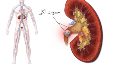 حصوات الكلى