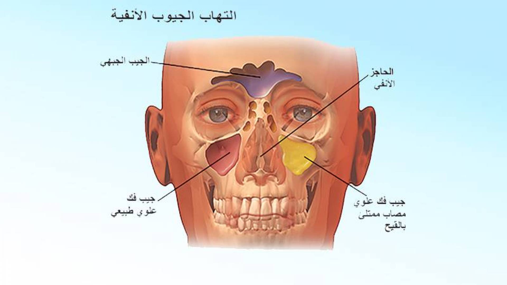 التهاب الجيوب الأنفية