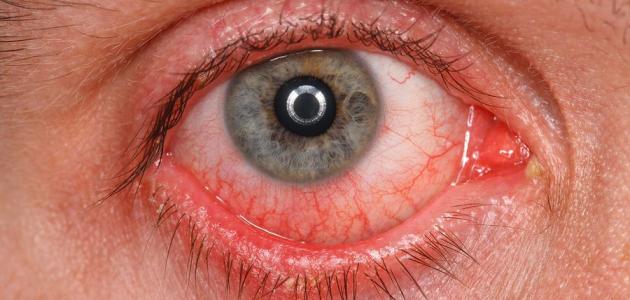 من الاعراض التي تدل على انسداد مجرى الدمع وجود احمرار في الجزء الابيض من العين