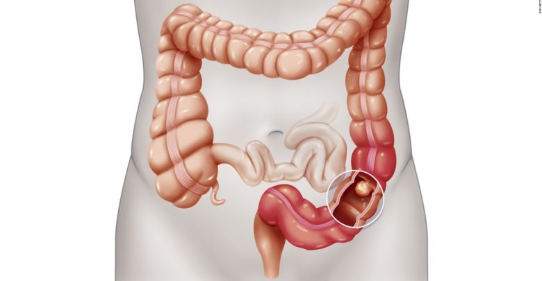 سرطان القولون و المستقيم