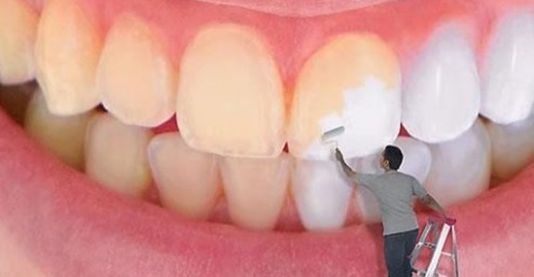 كيف يتم تبيض الأسنان