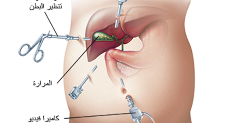 ما هو علاج حصوة المرارة بالجراحة؟