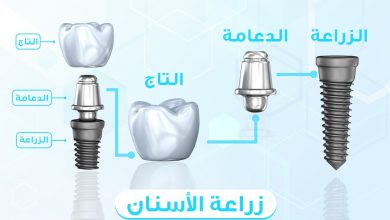 مراحل زراعة الاسنان