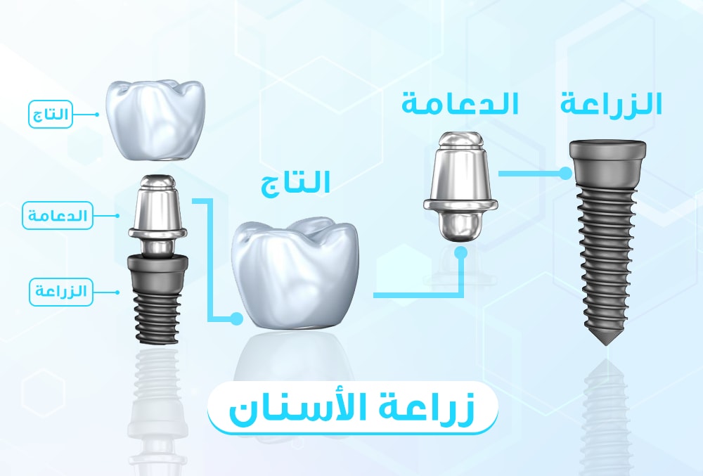 مراحل زراعة الاسنان