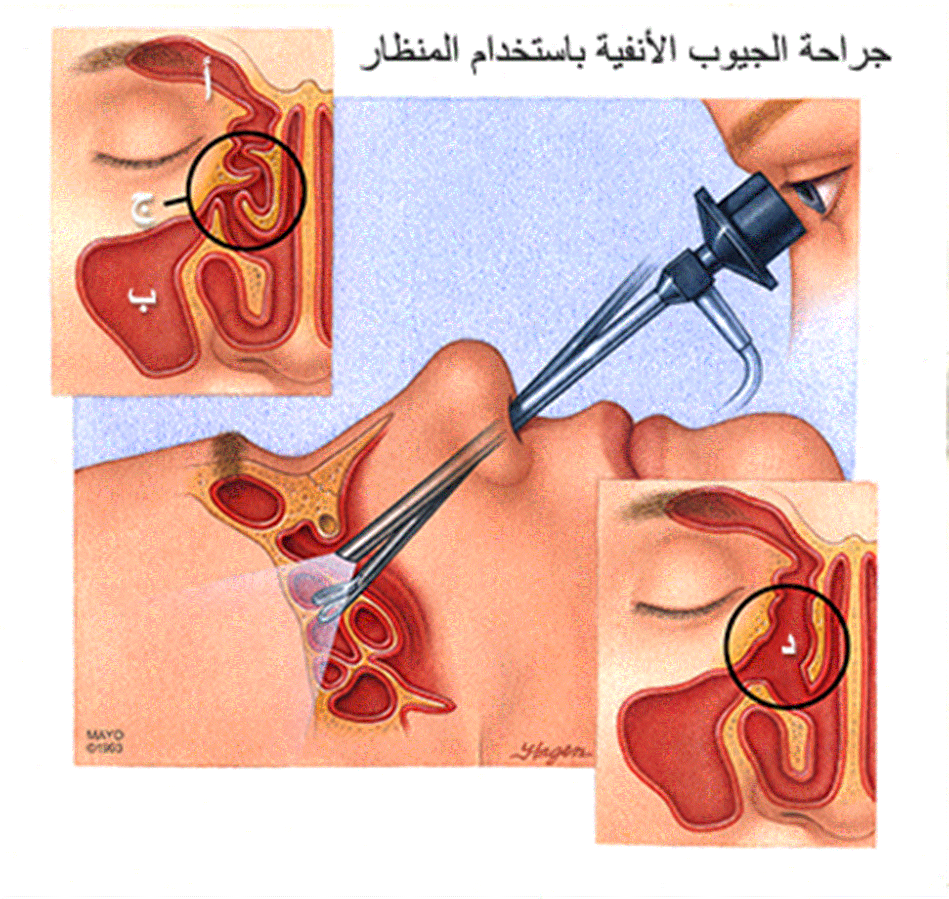 الجيوب الأنفية باستخدام المنظار