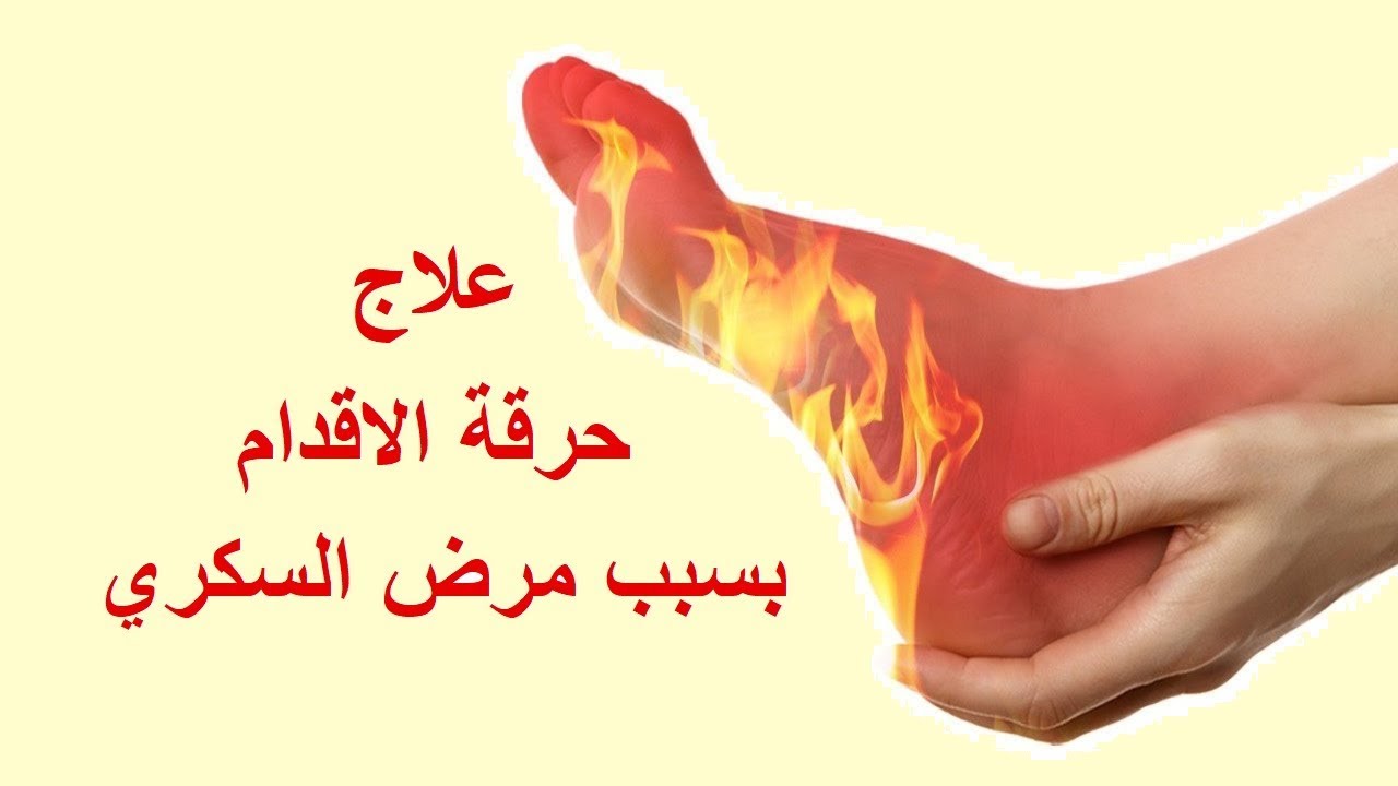 علاج حرقة الاقدام