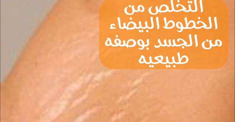 الخطوط البيضاء والتخلص منها