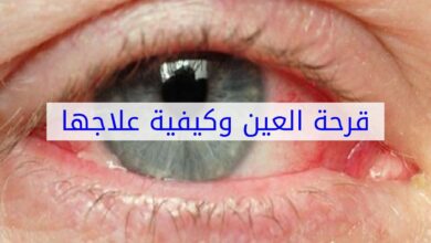علاج قرحة العين