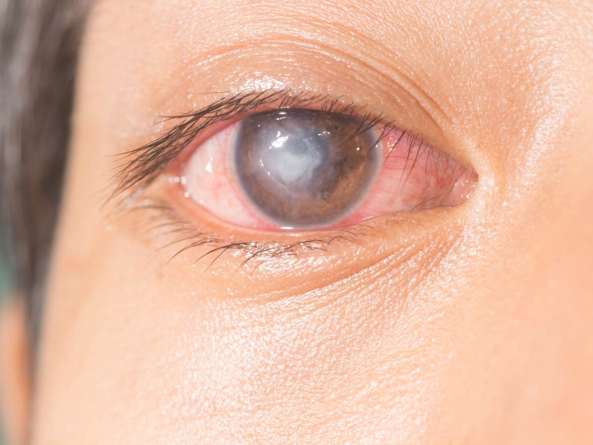 مرض قرحة العين