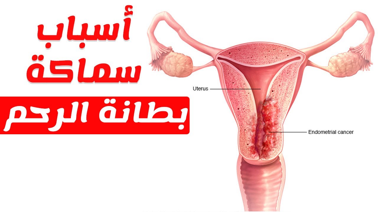 المهاجرة البطانة مرض البطانة