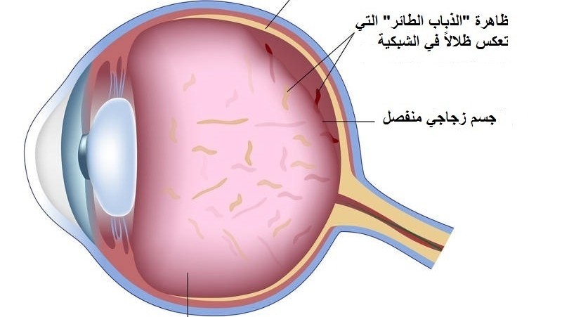ما هو ضغط العين وأعراض ارتفاع ضغط العين وعلاجه