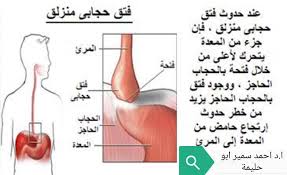 ماهو فتق الحجاب الحاجز