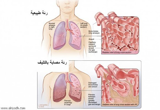 تليف الرئة و شكله