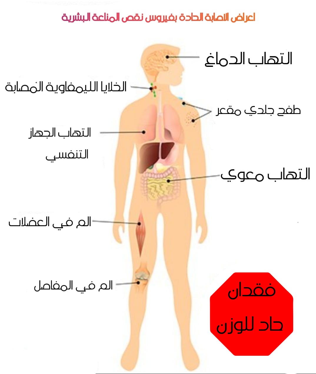 أعراض الإيدز