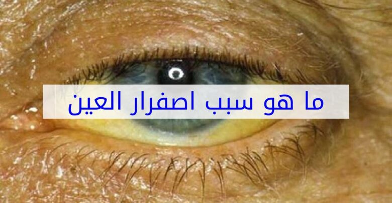 ما هو سبب اصفرار العين