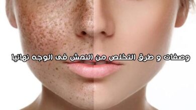 طرق التخلص من النمش