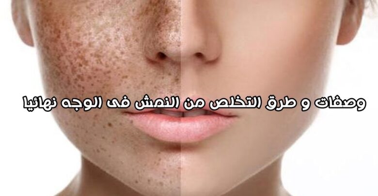 طرق التخلص من النمش