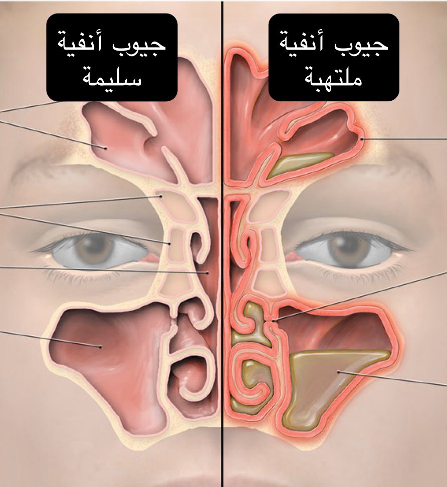 أنف ملتهبة وغير ملتهبة