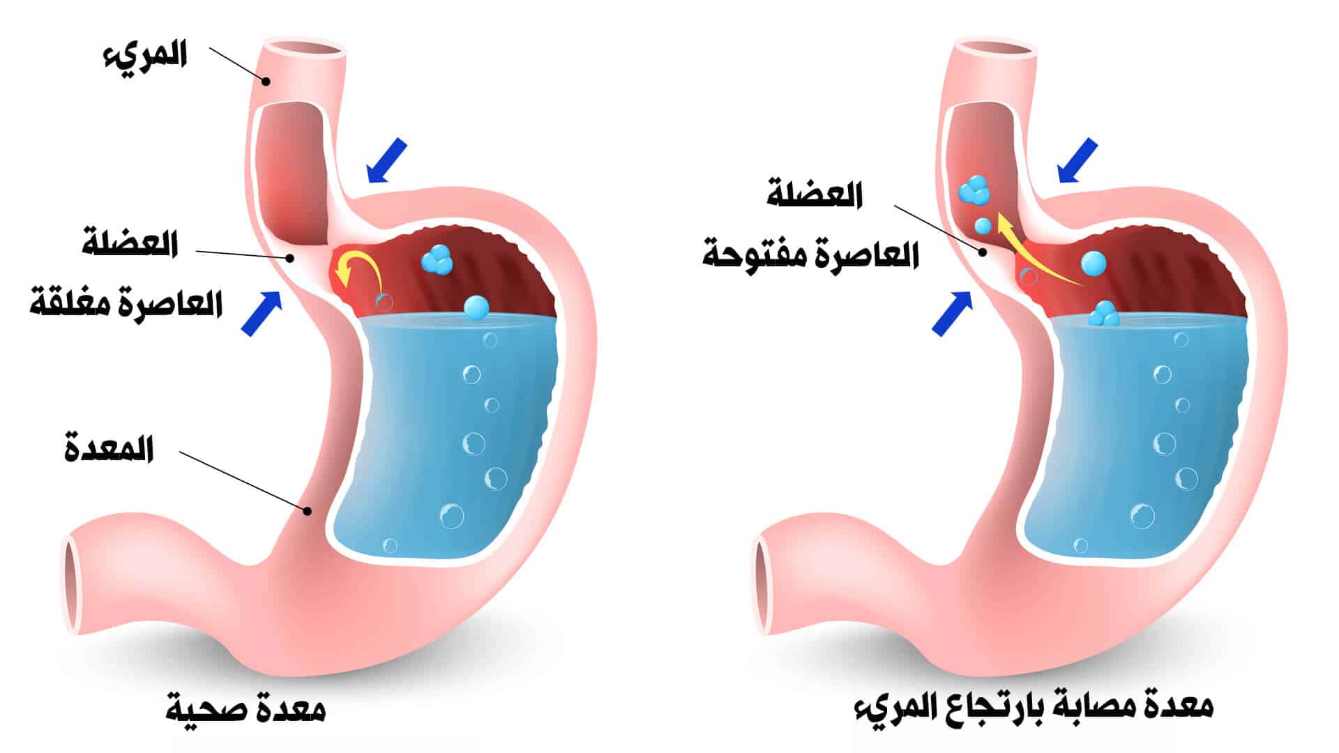 التهاب المريء