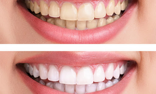 اختلاف في لون الاسنان