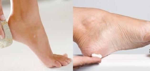 علاج تشققات الجلد في القدم و الكعبين.
