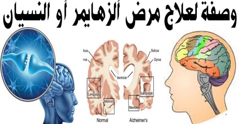 وصفة لعلاج مرض الزهايمر