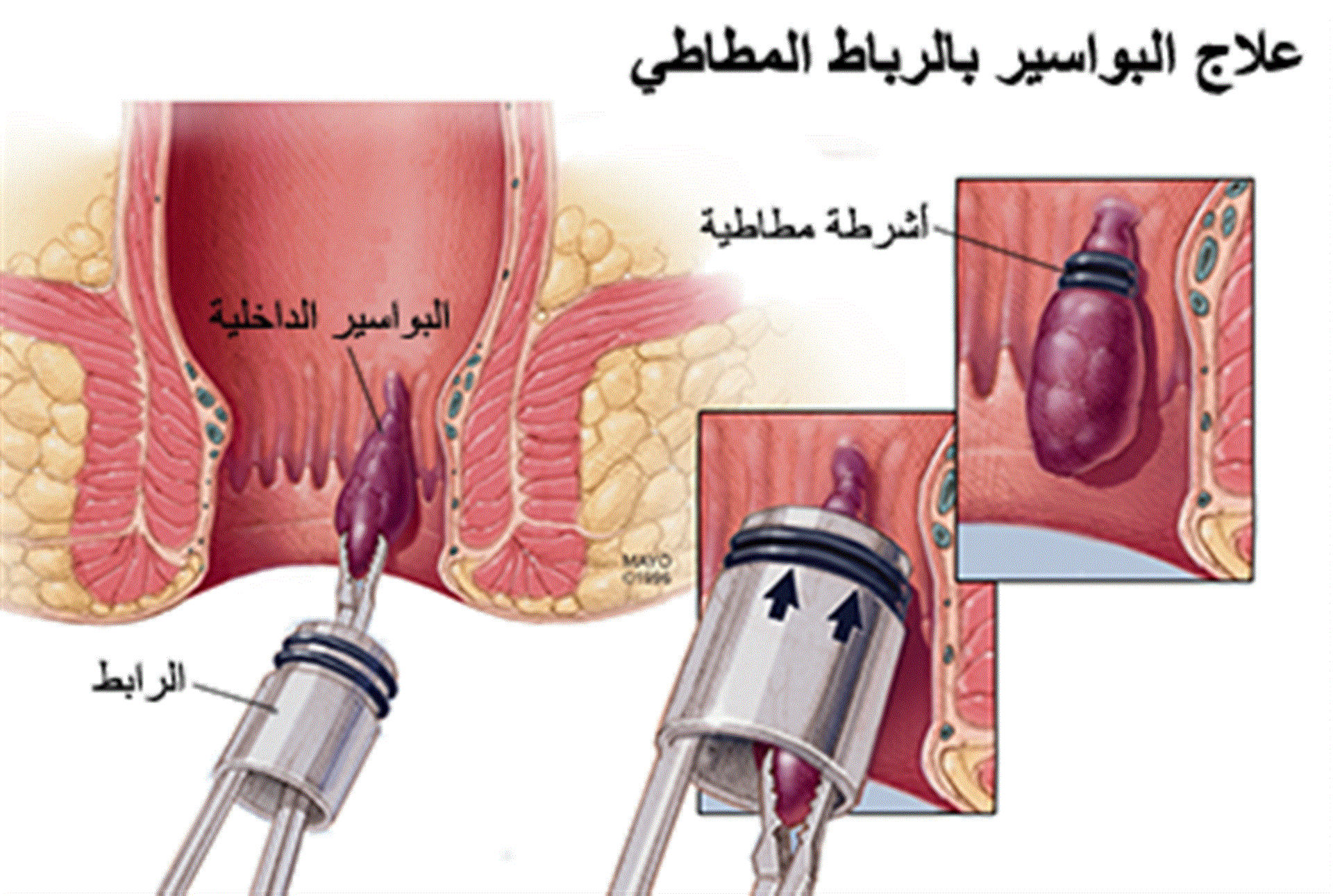 علاج البواسير