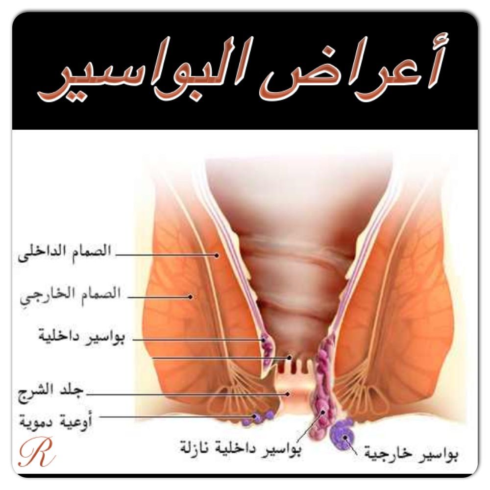 أعراض البواسير