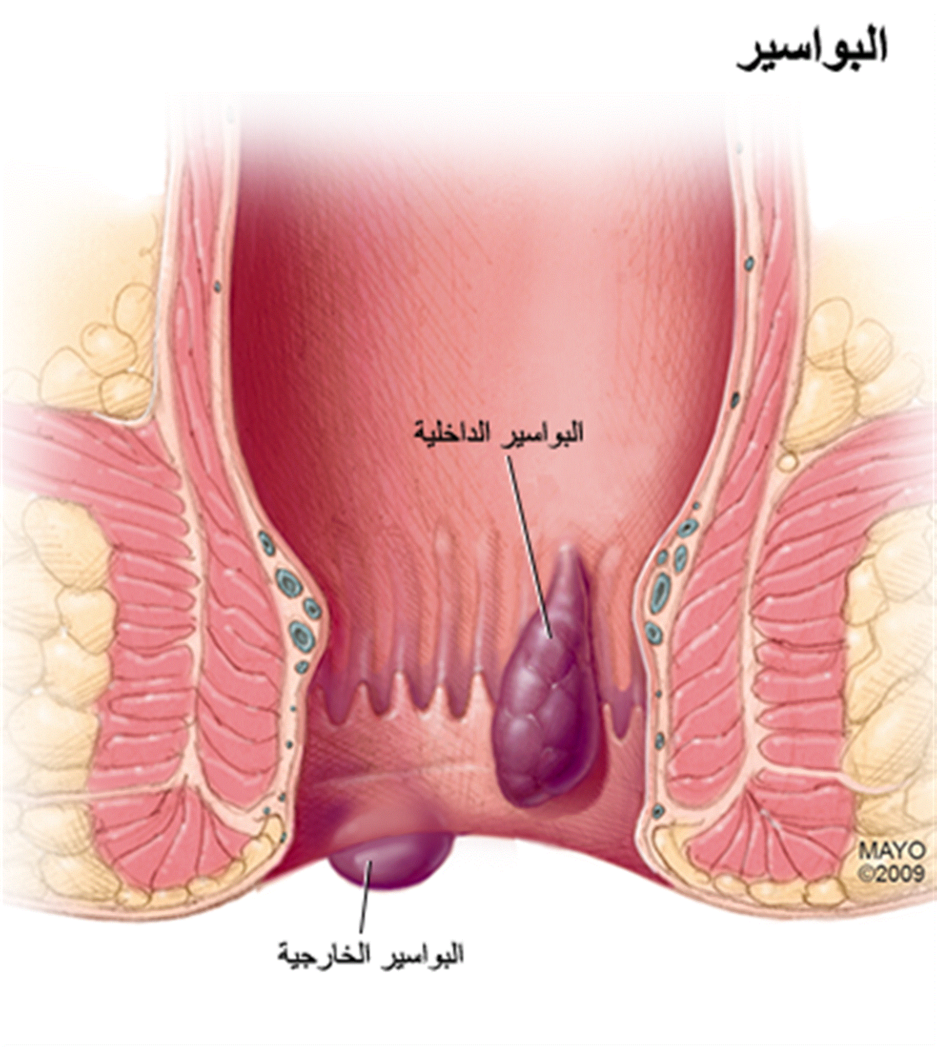 البواسير الداخلية والخارجية