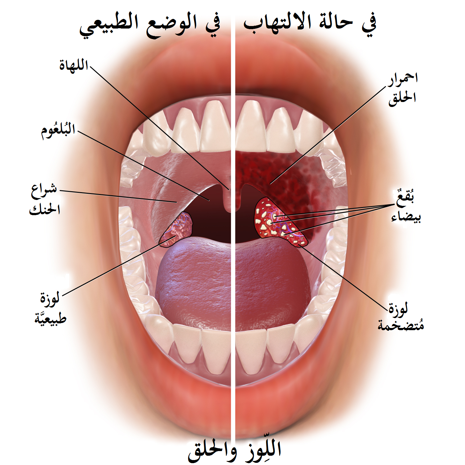 في حالة الالتهاب والوضع الطبيعي