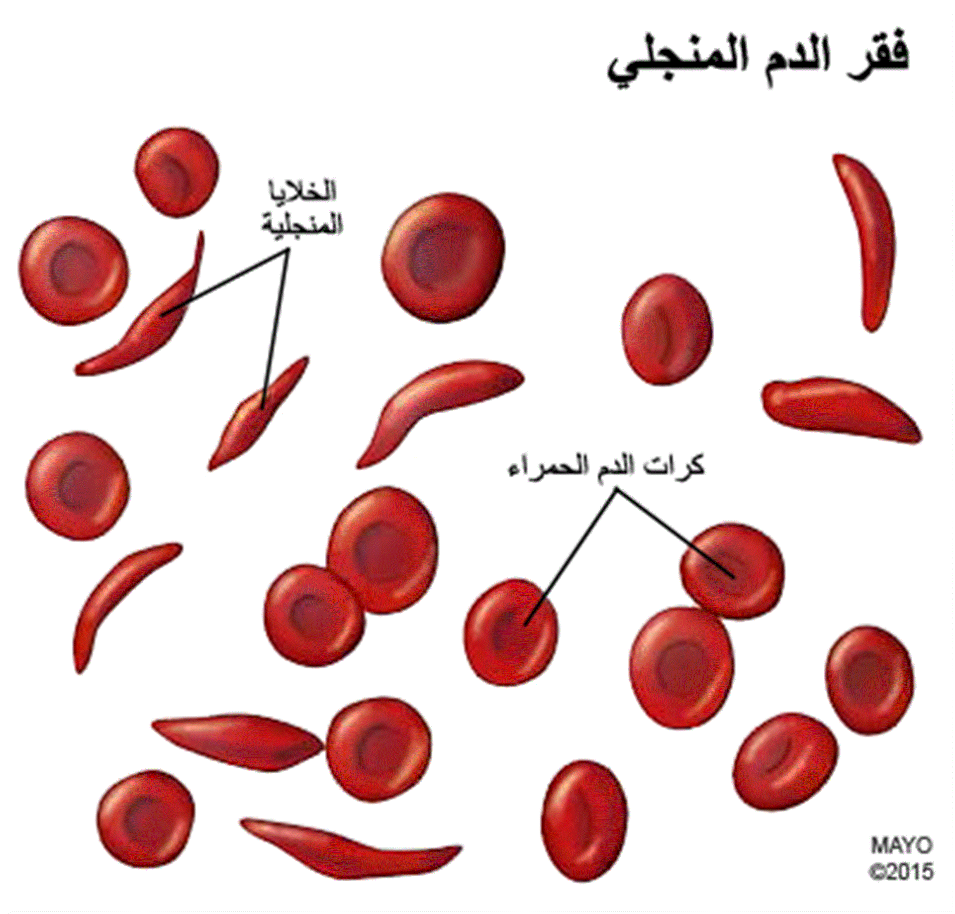 مرض فقر الدم المنجلي أعراضه ومضاعفاته