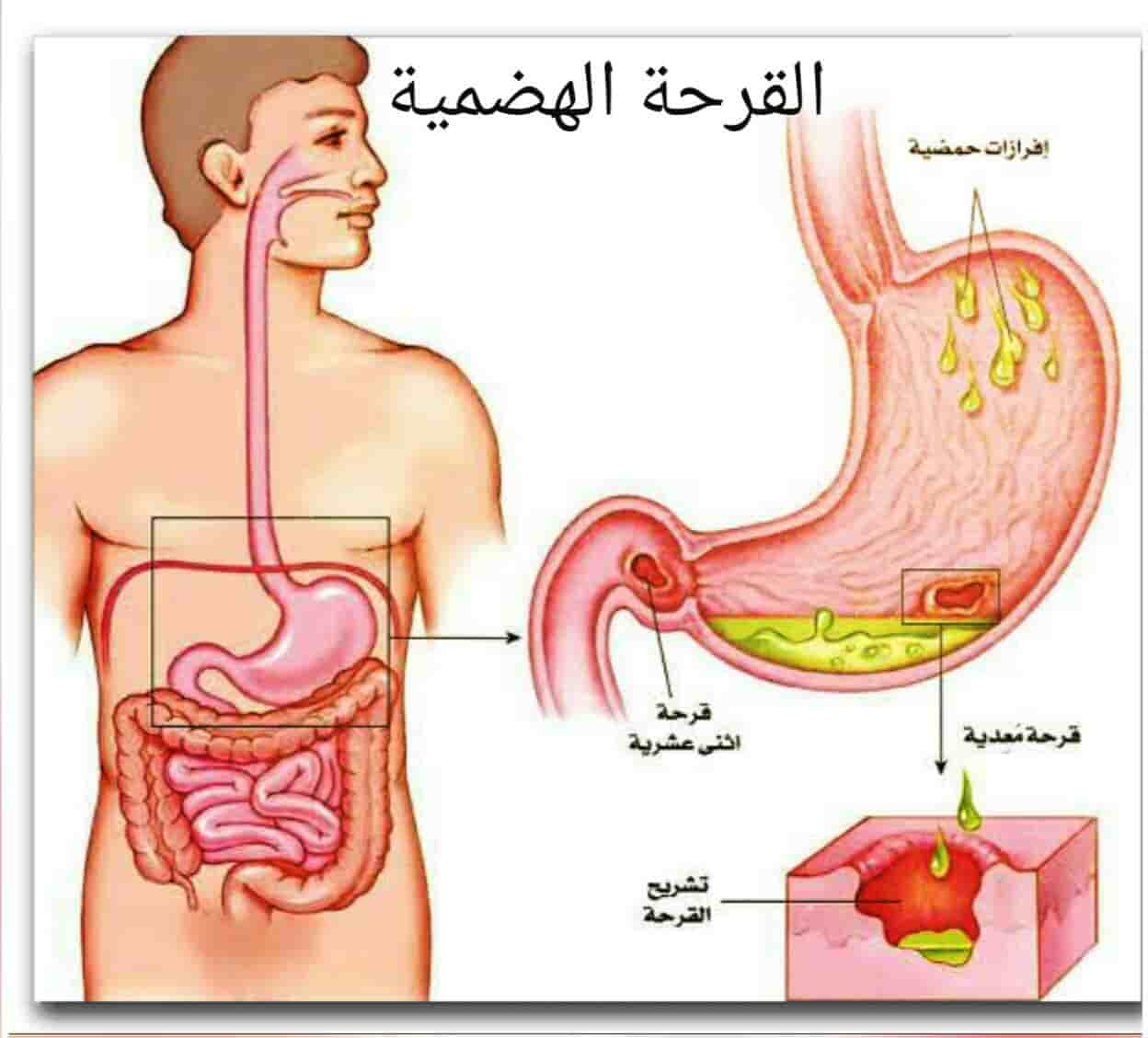 القرحة الهضمية