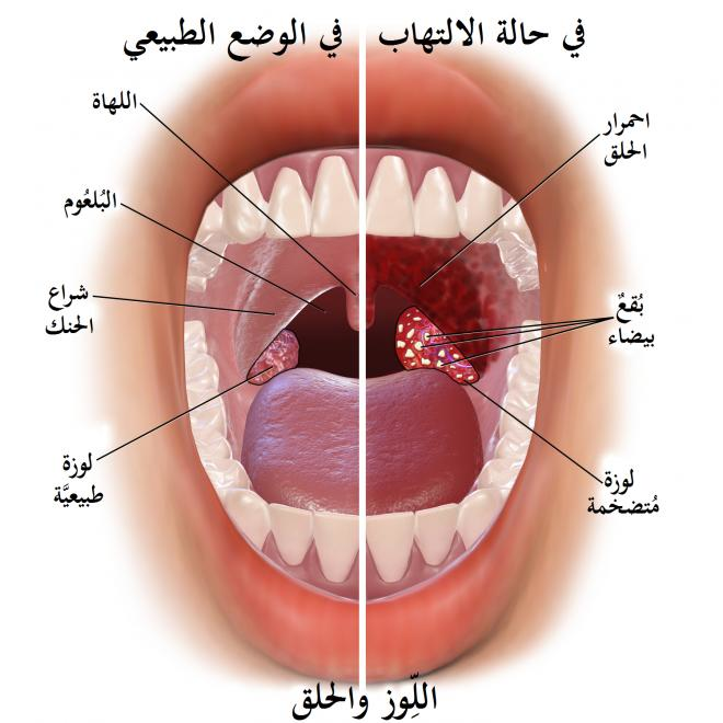 التهاب الحلق