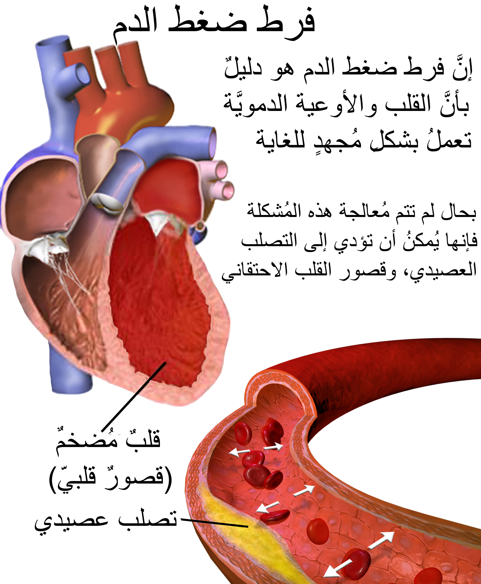 فرط ضغط الدم