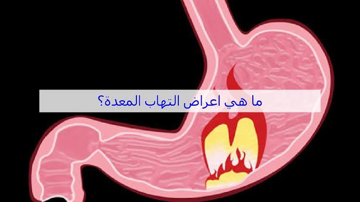 الأعراض الخاصة بالتهاب المعدة