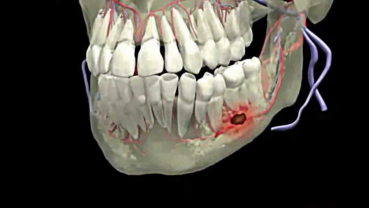 صورة توضح خراج الأسنان في الجزء السفلي من الفك