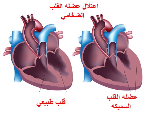 عضلة القلب المتضخمة.